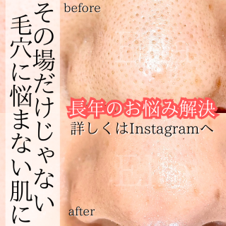 夏目前！毛穴ケア大人気です！